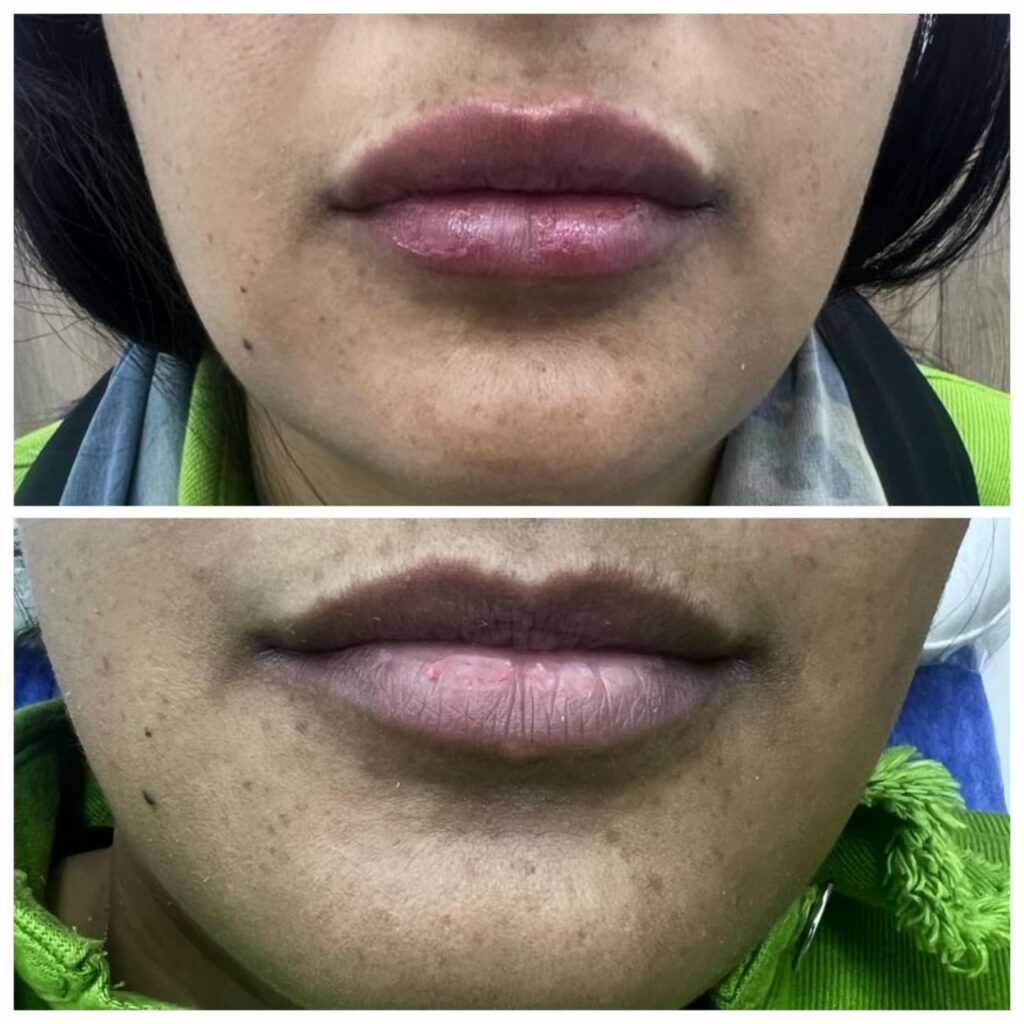 تفتيح الشفايف بحمض الهيالورونيك في مركز نضارة بالغردقة